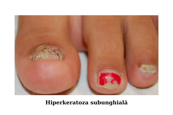 Hiperkeratoza subunghială