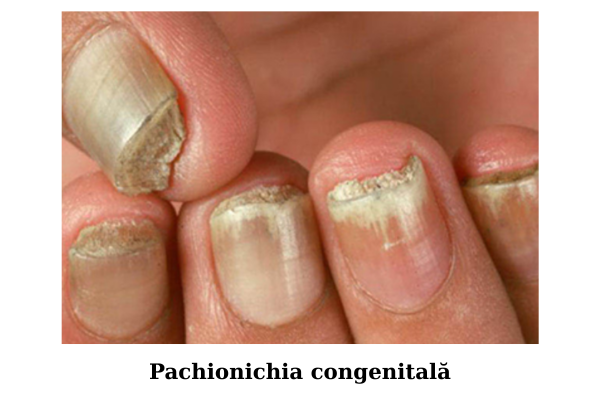 Pachionichia congenitală