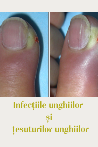 Infecțiile unghiilor și țesuturilor periunghiale 39 panaritiu