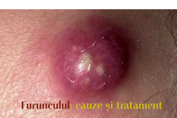 Furunculul: cauze și tratament 1 Furunculul cauze si tratament