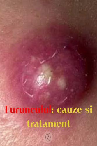 Furunculul: cauze și tratament 42 Furunculul cauze si tratament 2 uai