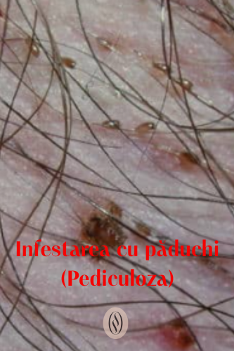 Infestarea cu păduchi (Pediculoza) 45 Infestarea cu păduchi (Pediculoza)