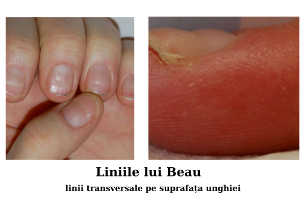 Bolile unghiilor - modificări de suprafața și formă a unghiilor 2 Liniile lui Beau - linii transversale pe suprafata unghiei