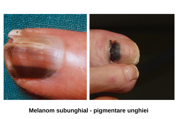 melanom subunghial