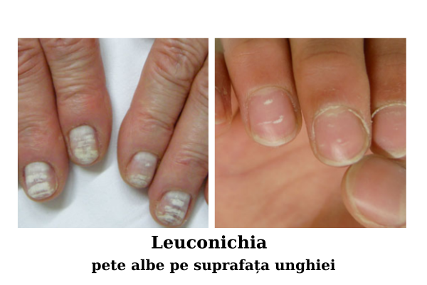 Bolile unghiilor - modificări de suprafața și formă a unghiilor 7 pete albe pe unghii - Leuconichia