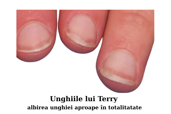 Bolile unghiilor - modificări de suprafața și formă a unghiilor 8 Unghiile lui Terry - albirea unghiei aproape in totalitate