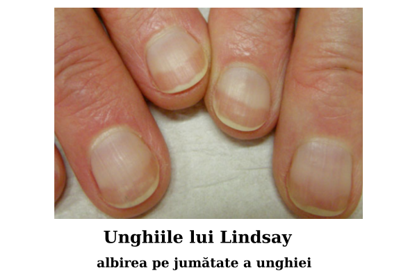 Bolile unghiilor - modificări de suprafața și formă a unghiilor 9 Unghiile lui Lindsay - albirea pe jumatate a unghiei