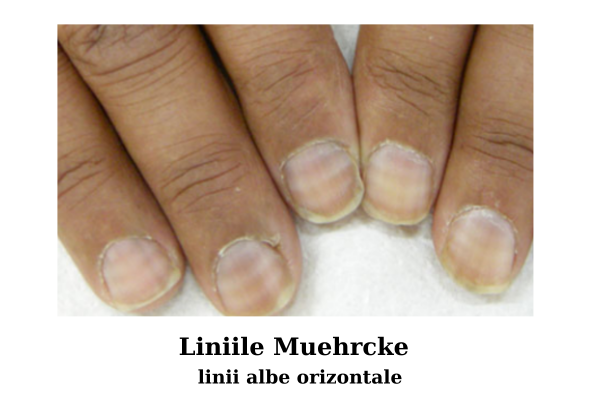 Liniile Muehrcke - linii albe orizontale - unghii