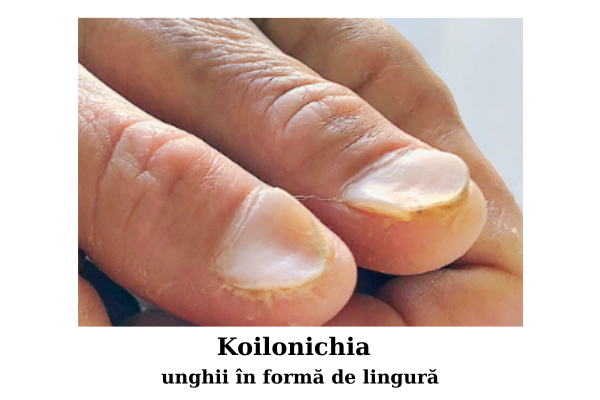 Bolile unghiilor - modificări de suprafața și formă a unghiilor 13 Koilonichia - unghii in forma de lingura