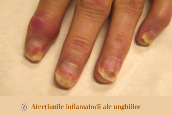 Afecțiunile inflamatorii ale unghiilor: identificarea și gestionarea lor 1 Afecțiunile inflamatorii ale unghiilor