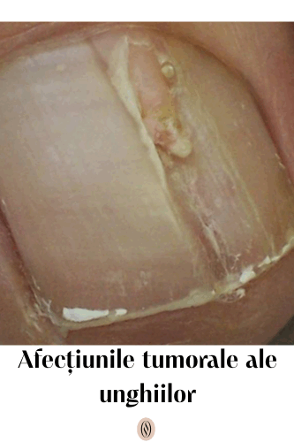 Afecțiunile tumorale ale unghiilor 37 Afecțiunile tumorale ale unghiilor