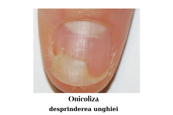 Onicoliza