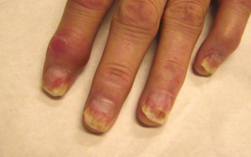 Afecțiunile inflamatorii ale unghiilor: identificarea și gestionarea lor 2 Artrită psoriazică și psoriazis unghial