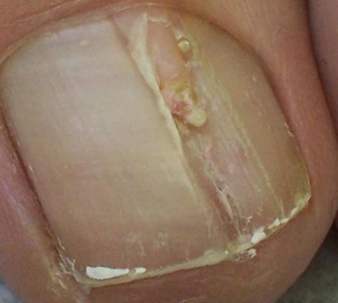 Afecțiunile tumorale ale unghiilor 2 Fibrokeratom subunghial