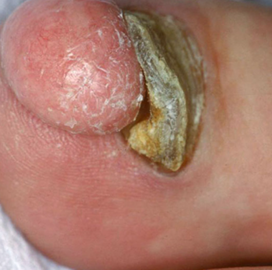 Afecțiunile tumorale ale unghiilor 3 Dermatofibrom subunghial