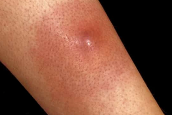 Furunculul: cauze și tratament 6 infectarea țesuturilor invecinate unui furuncul