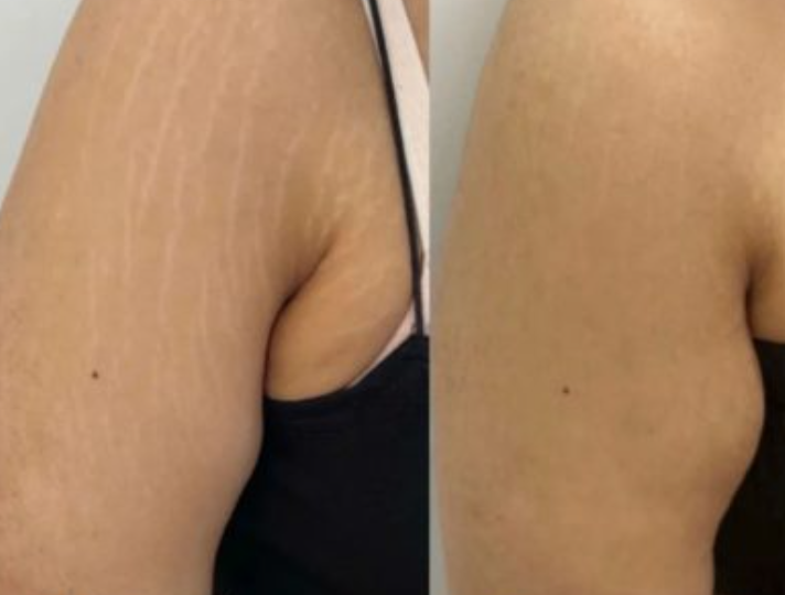 Rezultat obținut în tratarea vergeturilor cu terapia Microneedling