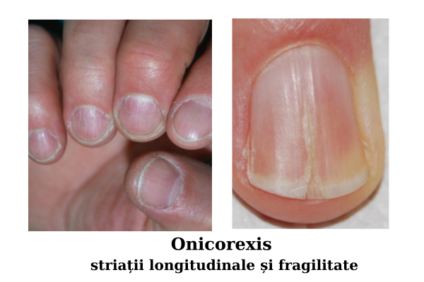 Bolile unghiilor - modificări de suprafața și formă a unghiilor 5 Onicorexis - striatii longitudinale si fragilitate
