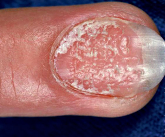 Afecțiunile inflamatorii ale unghiilor: identificarea și gestionarea lor 3 Depresiuni pe suprafața unghiei în psoriazisul unghial