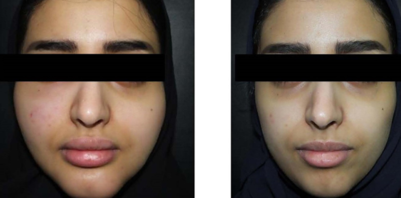 Mărirea buzelor a eșuat? Corectează cu hialuronidaza 6 reactie alergica la acid hialuronic