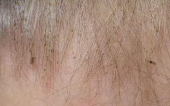 Infestarea cu păduchi (Pediculoza) 5 cum-identifici-paduchii
