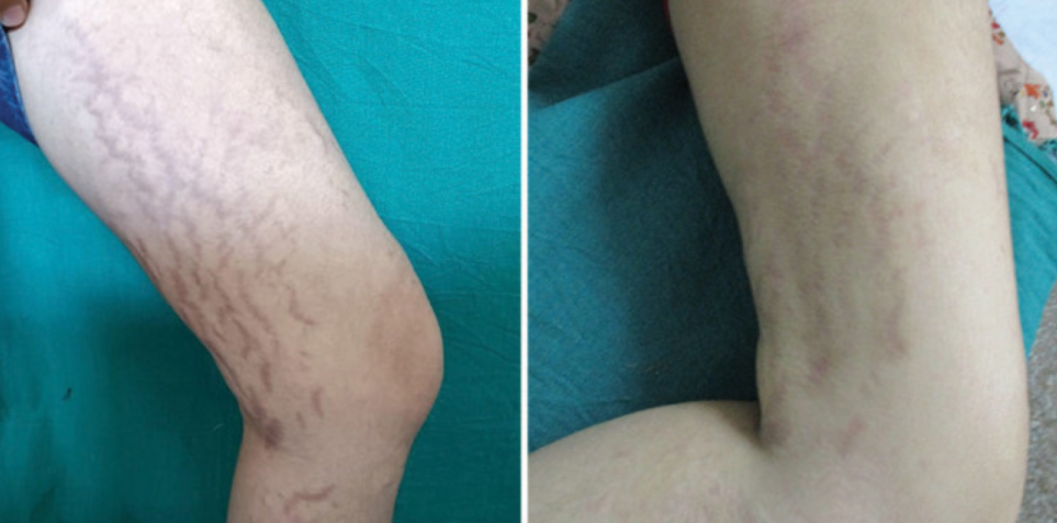Rezultat obținut în tratarea vergeturilor folosind combinarea PRP cu microneedling