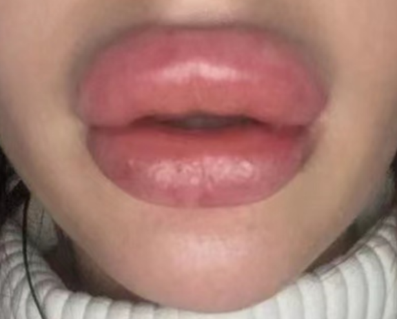Mărirea buzelor a eșuat? Corectează cu hialuronidaza 3 volum excesiv al buzelor