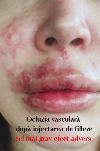Ocluzia vasculară după injectarea fillerelor: cel mai grav efect advers 30 Pitiriazis Versicolor Tinea Versicolor 17 uai