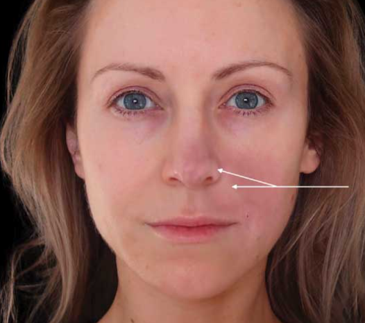 Ocluzia vasculară după injectarea fillerelor: cel mai grav efect advers 2 albirea pielii in ocluzia vasculara
