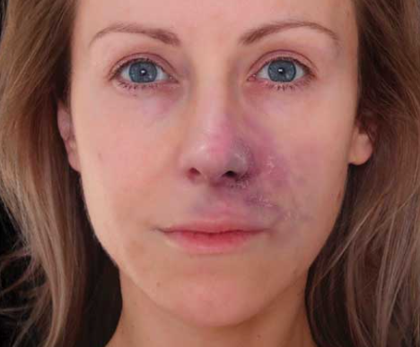 Ocluzia vasculară după injectarea fillerelor: cel mai grav efect advers 3 livido reticularis