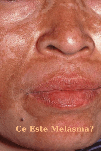 Ce Este Melasma? 19 Ce este melasma