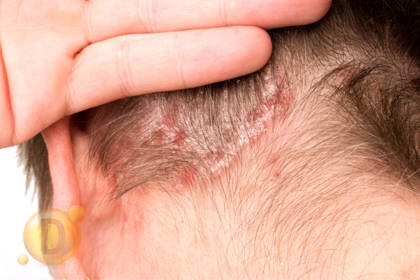 Deficiența de vitamină D, implicații asupra pielii și părului 4 vitamina D si psoriazisul