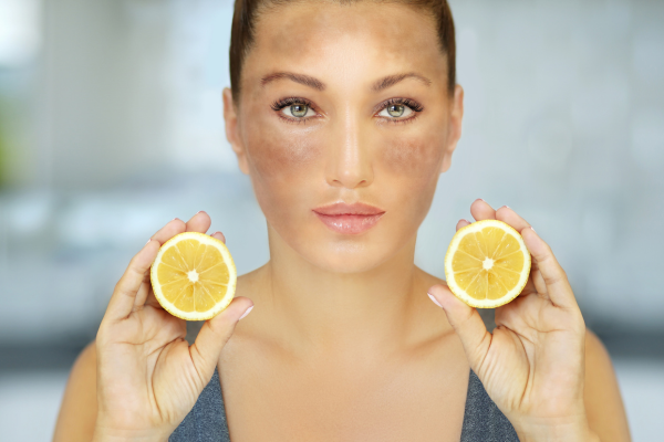 Tratamentul pentru Melasmă: Soluții Eficiente pentru Piele Fără Pete (partea 1) 3 tratamente naturale pentru melasma
