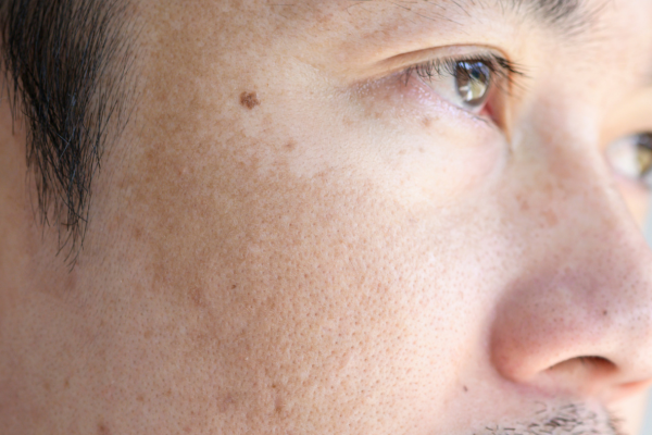 Ce Este Melasma? 4 melasma