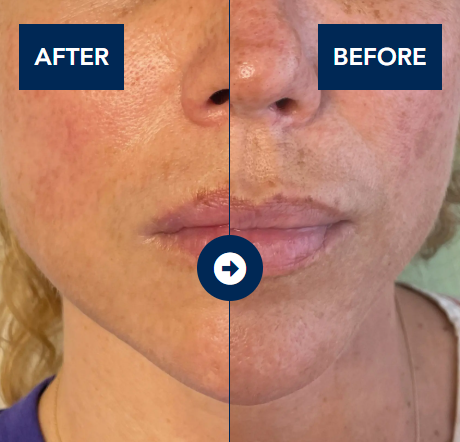Tratamentul pentru Melasmă: Soluții Eficiente pentru Piele Fără Pete (partea 2) 5 Luminescence pt melasma