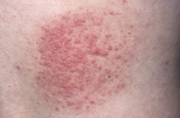 Deficiența de vitamină D, implicații asupra pielii și părului 10 alergia la soare și vitamina D