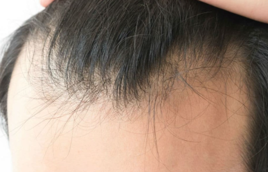 Deficiența de vitamină D, implicații asupra pielii și părului 12 alopecia si vit D