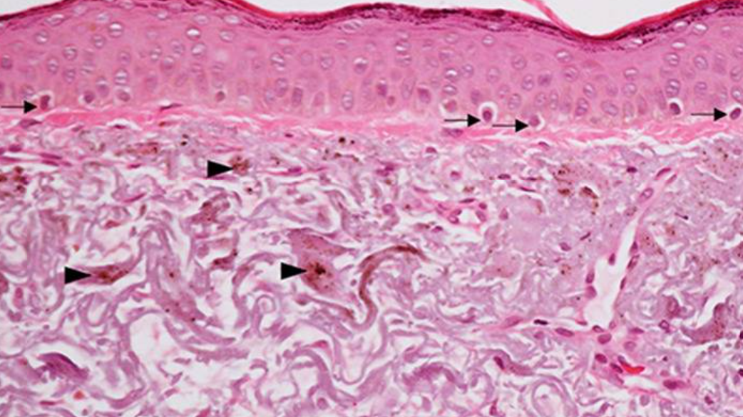 cum apare melasma in derm