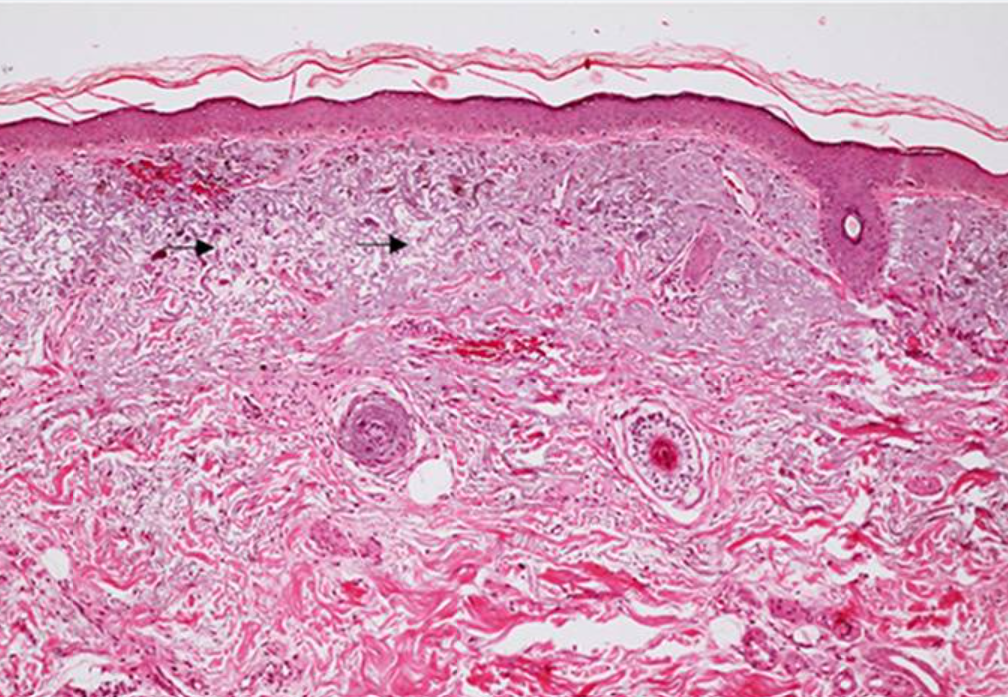 Cum apare melasma? 4 cum apare melasma in epiderm