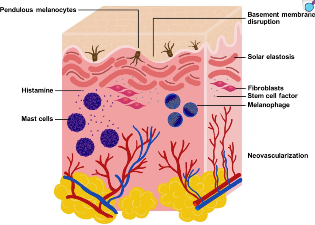 Cum apare melasma? 6 cum apare melasma