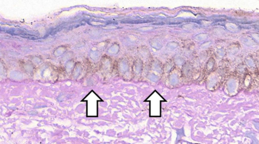 Cum apare melasma? 3 discontinuitati in membrana bazala