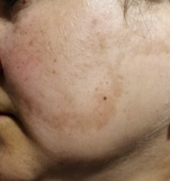 Ce Este Melasma? 7 pete maronii pe fata