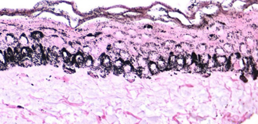 Cum apare melasma? 2 melanocite in toate straturile pielii