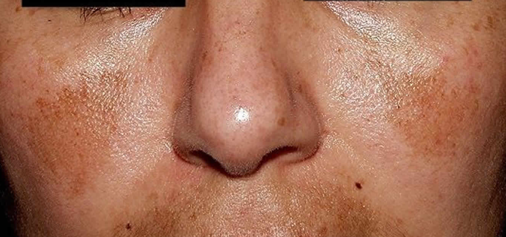 melasma dermica