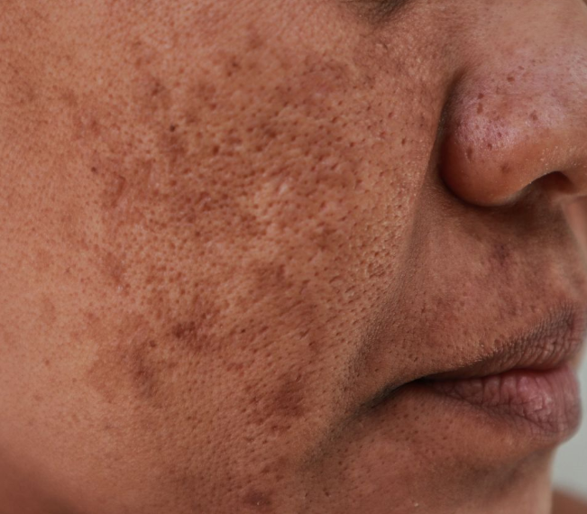 Ce Este Melasma? 11 melasma dermica