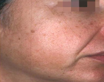 Ce Este Melasma? 8 melasma mandibulara