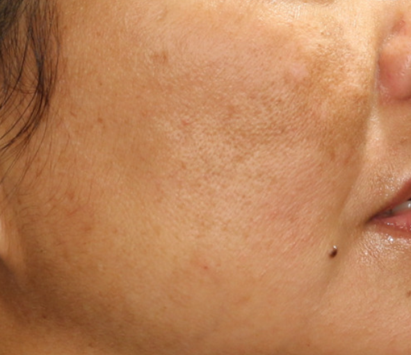 melasma mixta