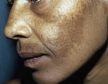 Ce Este Melasma? 2 melasma obrajilor