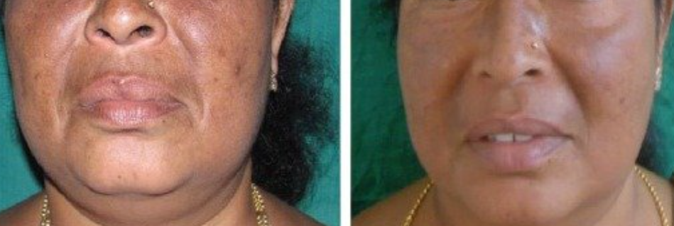 Tratamentul pentru Melasmă: Soluții Eficiente pentru Piele Fără Pete (partea 2) 4 melasma si microneedling