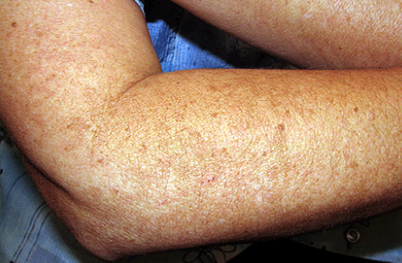 Ce Este Melasma? 9 pete maro maini